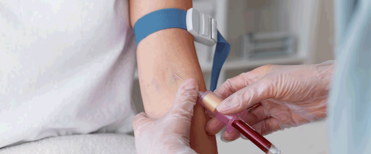 J&J Begins Trial of Tip-Based Javelin IVL Catheter for Hard-to-Treat Arteries