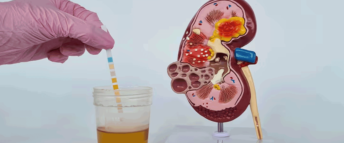 EG 427’s EG110A Gene Therapy Shows >80% Reduction in Urinary Incontinence Episodes in NDO Patients