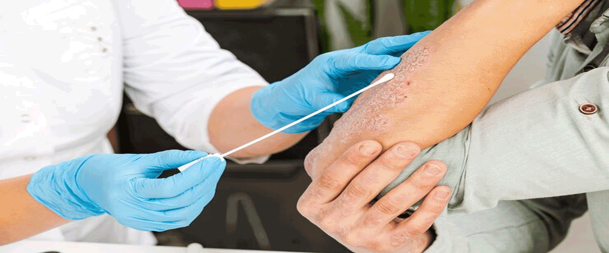J&J Reports Strong One-Year Results for Icotyde in Plaque Psoriasis