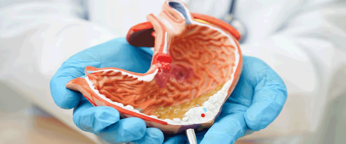 Domvanalimab Shows Encouraging Phase II OS Data in Gastroesophageal Adenocarcinoma