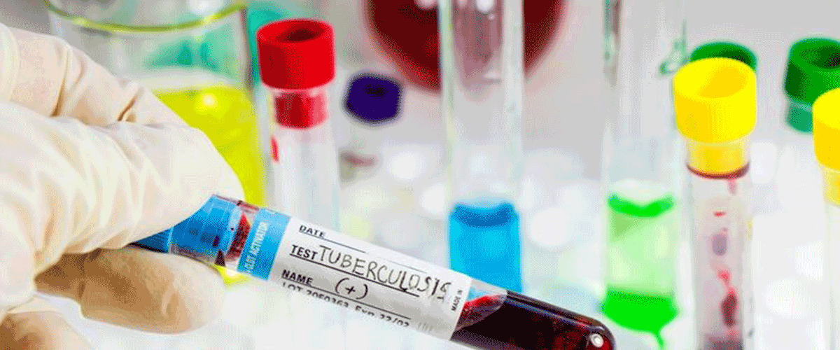 Roche’s Blood Test Gains CE Mark for Ruling Out Alzheimer’s Disease