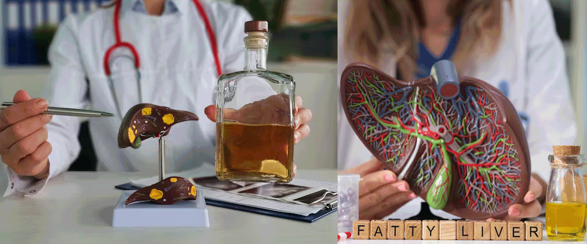 A safe, cheap vitamin shows promise in Fatty liver